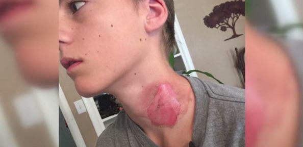 Burn on young boy's neck.
